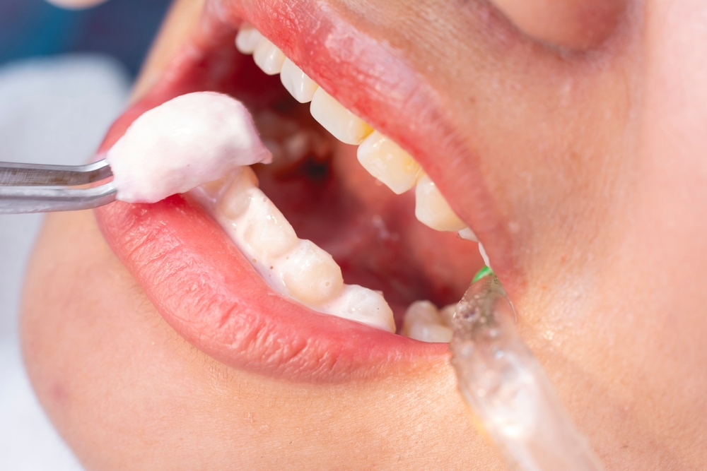 Fluoride treatment New Holland